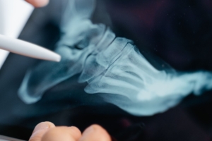 Yeni sistem, hallux valgus görüntülerini anatomik olarak üretiyor